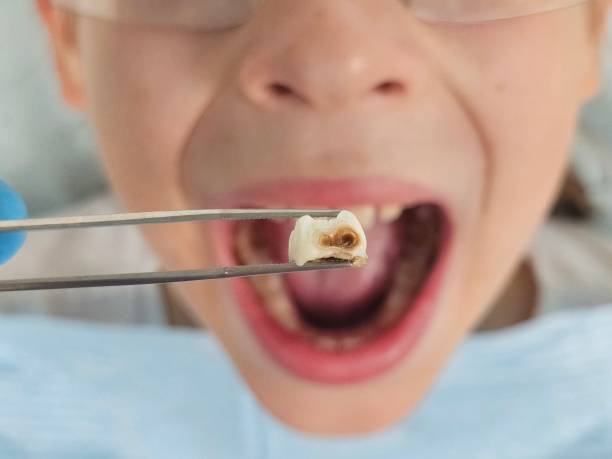 Best Emergency Broken Tooth Repair in West Concord, MA